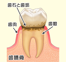 歯周病の進行1