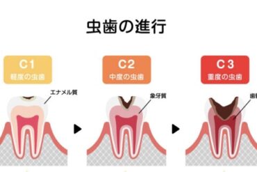 ８０２０運動とは？