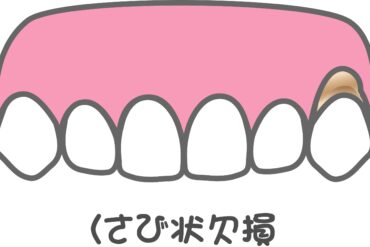 口腔カンジダ症
