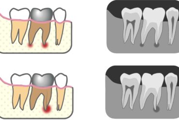 矯正について🫧