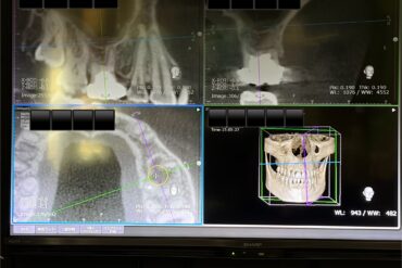 糖尿病と歯周病